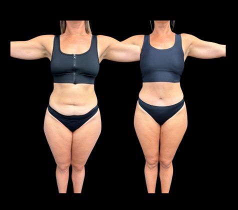 Liposuction Cases