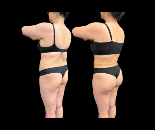 Brazilian Butt Lift Cases