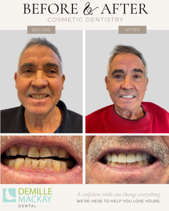 Veneers and Crowns: Case 6 - Before & After
