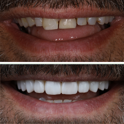 No Prep Porcelain Veneers Robert - Before