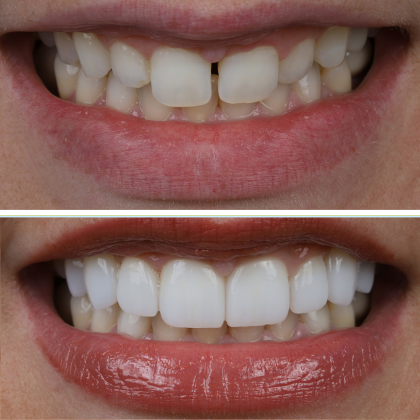 No Prep Porcelain Veneers Stephanie - Before