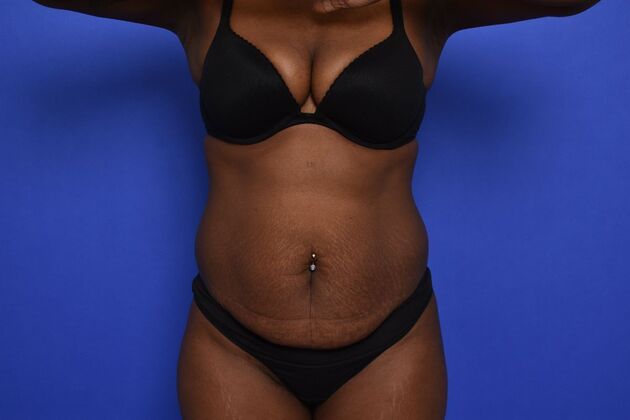 Tummy Tuck with LipoContouring Case 33  - Before