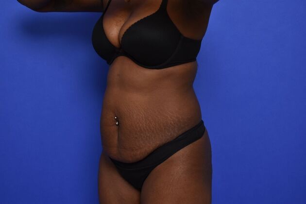Tummy Tuck with LipoContouring: Case 33 - Before