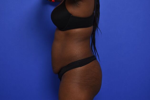 Tummy Tuck with LipoContouring: Case 33 - Before