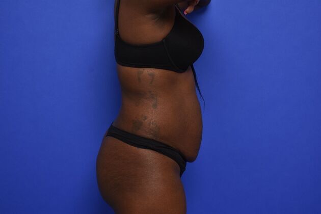 Tummy Tuck with LipoContouring: Case 33 - Before