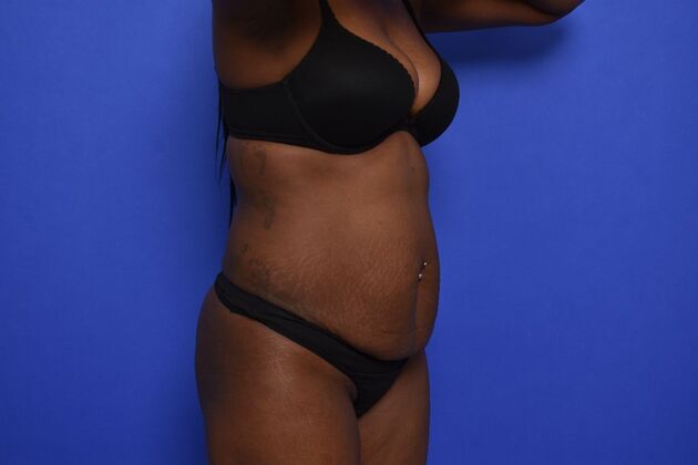 Tummy Tuck with LipoContouring: Case 33 - Before