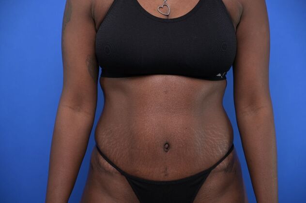 Tummy Tuck with LipoContouring Case 33  - After