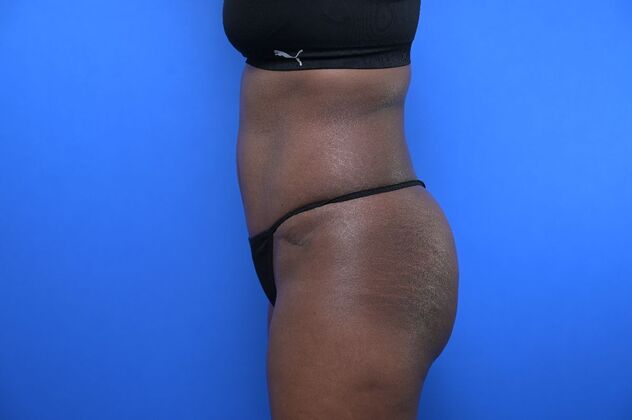 Tummy Tuck with LipoContouring: Case 33 - After