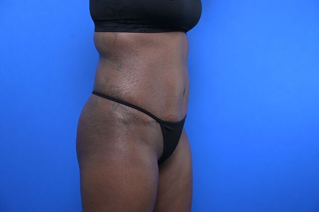 Tummy Tuck with LipoContouring: Case 33 - After