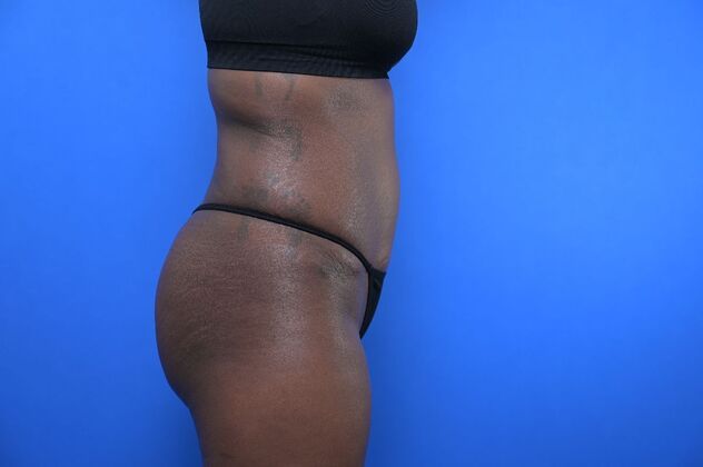 Tummy Tuck with LipoContouring: Case 33 - After