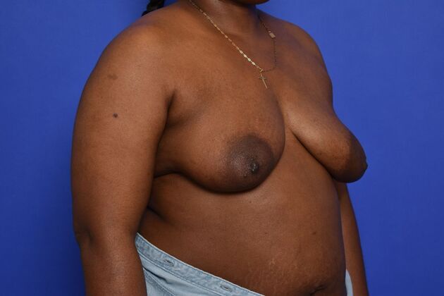 Oncoplastic Breast Reduction: Case 9 - Before