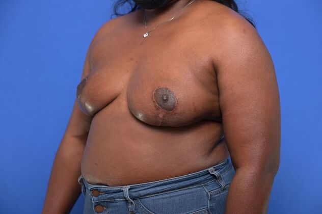 Oncoplastic Breast Reduction: Case 9 - After