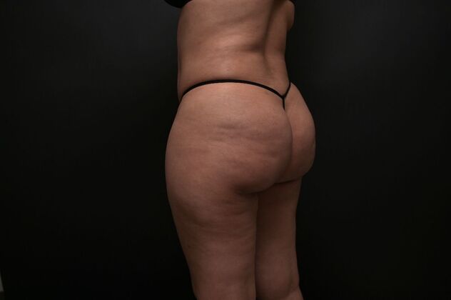 Brazilian Butt Lift (Augmentation): Case 18 - After