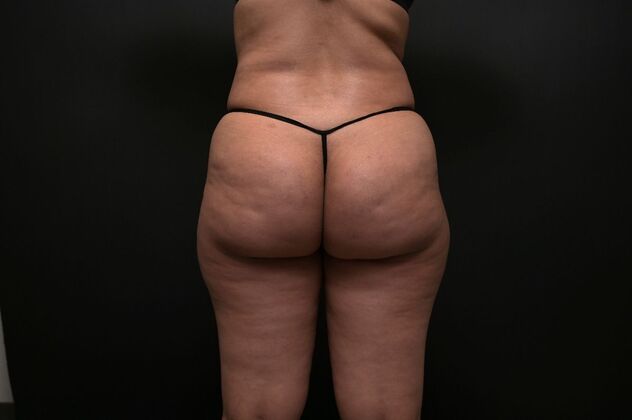 Brazilian Butt Lift (Augmentation): Case 18 - After