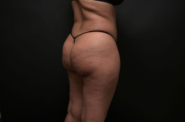 Brazilian Butt Lift (Augmentation): Case 18 - After