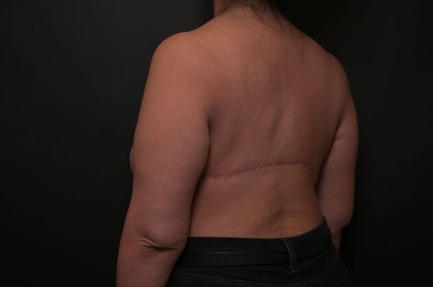 Torsoplasty: Case 3 - After