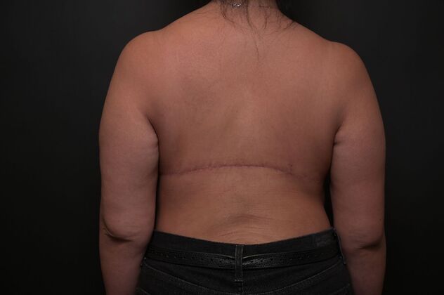 Torsoplasty: Case 3 - After