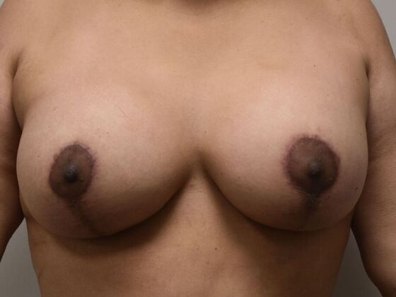 Breast Augmentation w/ Lift: Case 678 - After