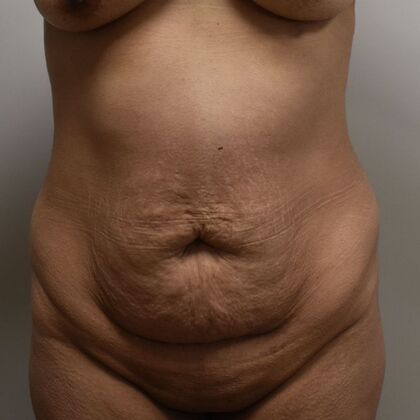 Tummy Tuck (Abdominoplasty) Case 617 - Before
