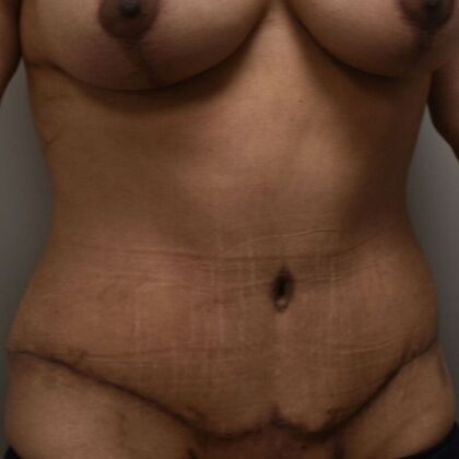 Tummy Tuck (Abdominoplasty): Case 617 - After