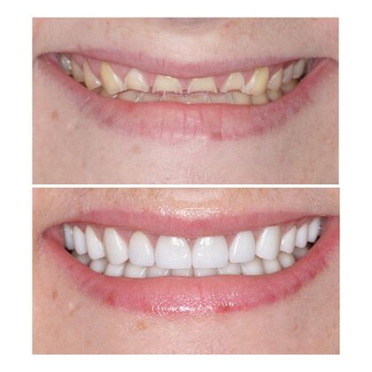 Smile Gallery  Case 2 