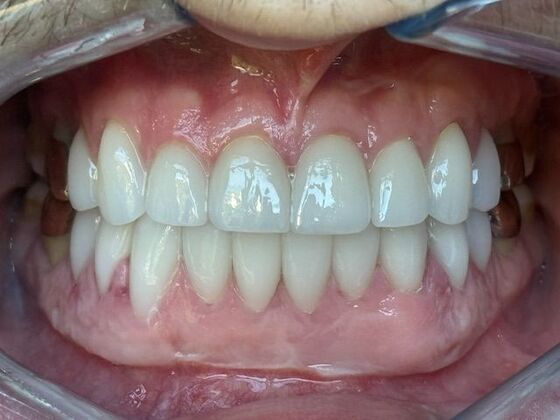 Smile Makeovers: Case 29 - After