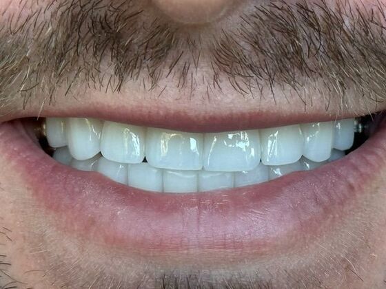 Smile Makeovers: Case 29 - After