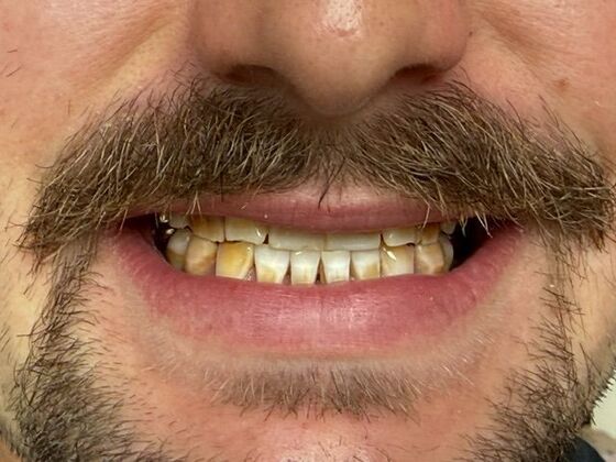 Smile Makeovers: Case 29 - Before