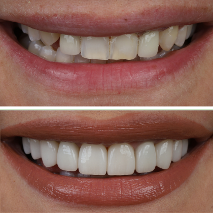 No Prep Porcelain Veneers Jessica - Before