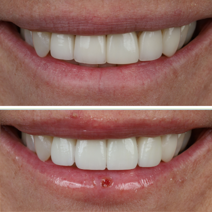 Minimal Prep Porcelain Veneers Heidi - Before