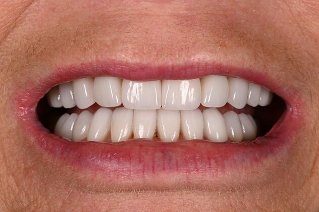 Before and Afters: Case - Full Mouth Reconstruction - After