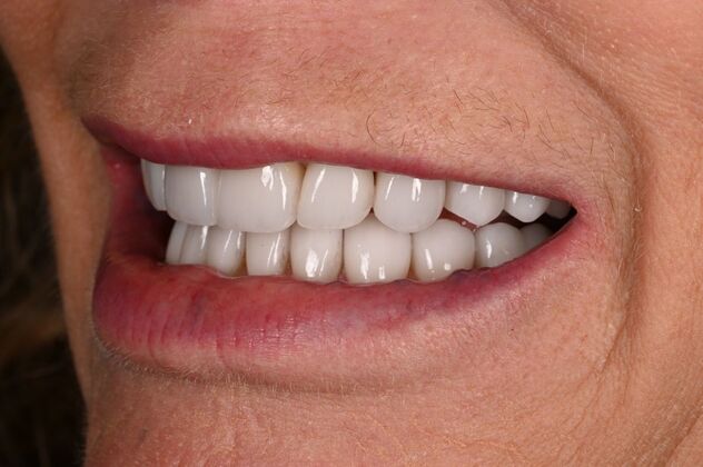Before and Afters: Case - Full Mouth Reconstruction - After