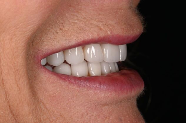 Before and Afters: Case - Full Mouth Reconstruction - After