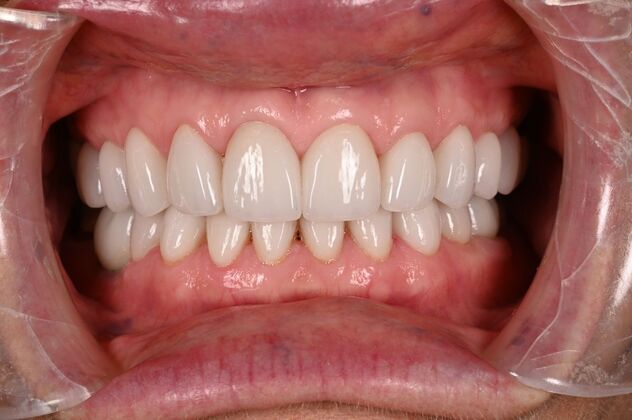 Before and Afters: Case - Full Mouth Reconstruction - After