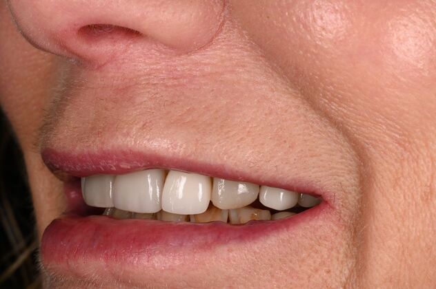 Before and Afters: Case - Full Mouth Reconstruction - Before