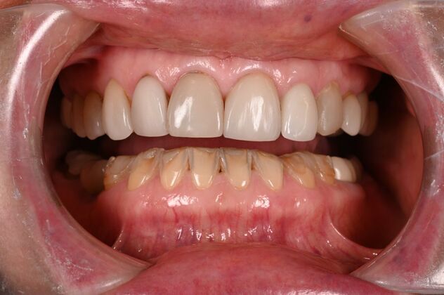 Before and Afters: Case - Full Mouth Reconstruction - Before