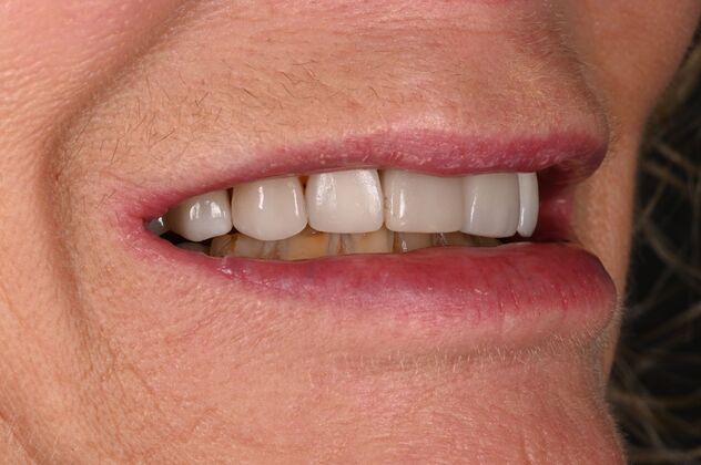 Before and Afters: Case - Full Mouth Reconstruction -  Before 