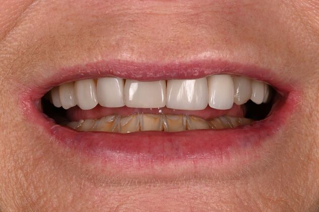 Before and Afters: Case - Full Mouth Reconstruction - Before