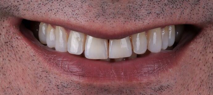 Smile Makeover & Veneers: Marcus - Before