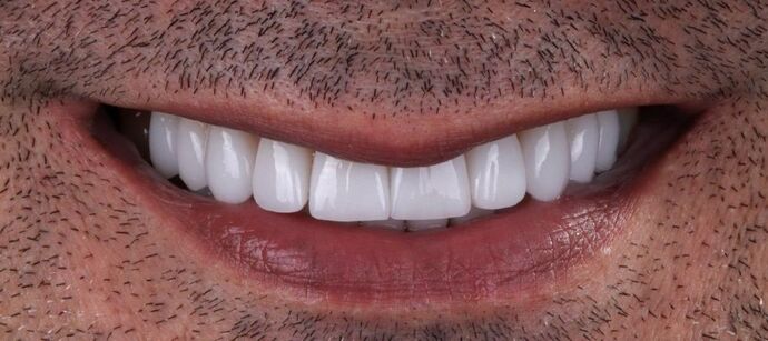 Smile Makeover & Veneers Marcus