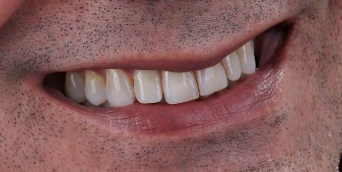 Smile Makeover & Veneers: Marcus - Before