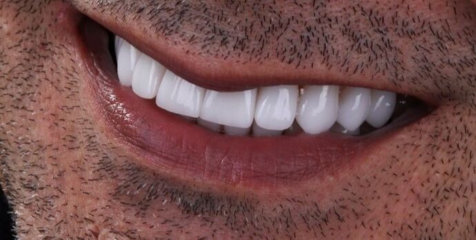 Smile Makeover & Veneers: Marcus - After