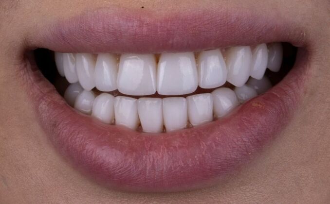 Smile Makeover & Veneers Natalie