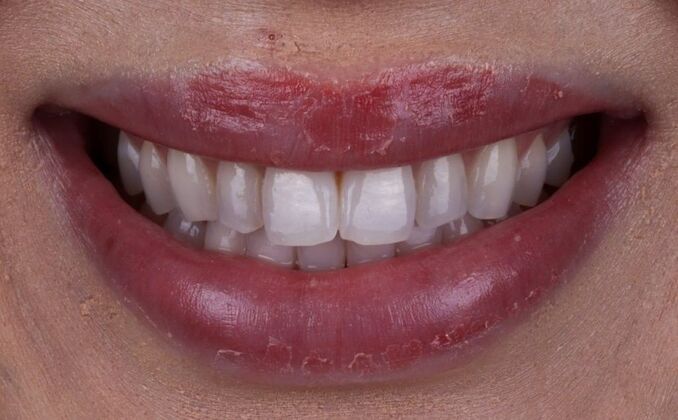 Smile Makeover & Veneers: Natalie - Before