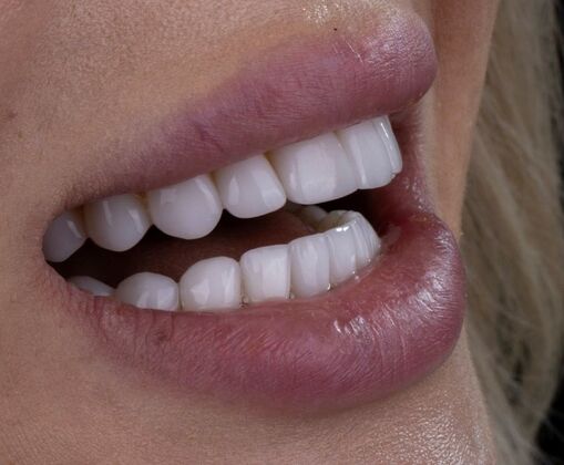 Smile Makeover & Veneers: Natalie - After