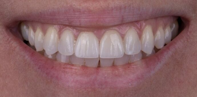Smile Makeover & Veneers: Marisol - Before
