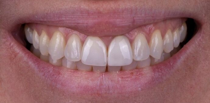 Smile Makeover & Veneers: Marisol - After