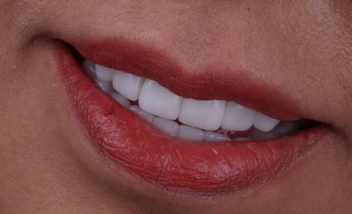Smile Makeover & Veneers Delia