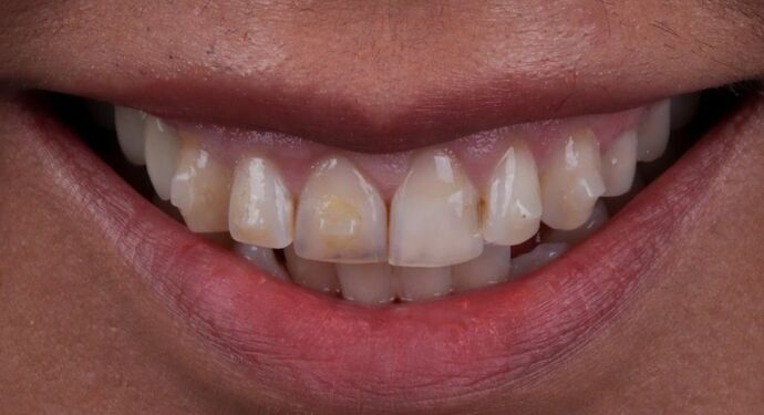 Smile Makeover & Veneers: Delia - Before