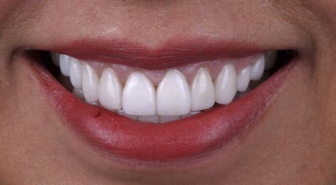 Smile Makeover & Veneers: Delia - After